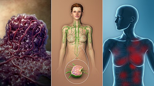 The TNM Cancer Staging System: Essential Principles for FRCR Part 1 Success