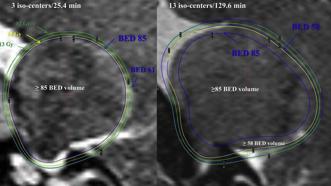 Biologically Effective Dose (BED) and EQD2: The FRCR Part 1 Calculation Guide